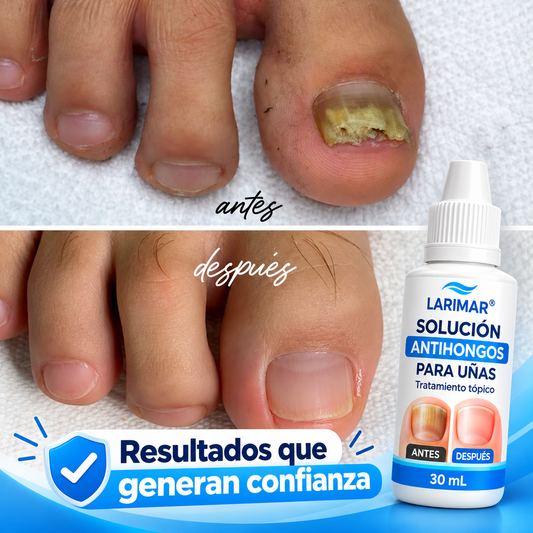 Larimar: Solución Tópica para Uñas Amarillentas